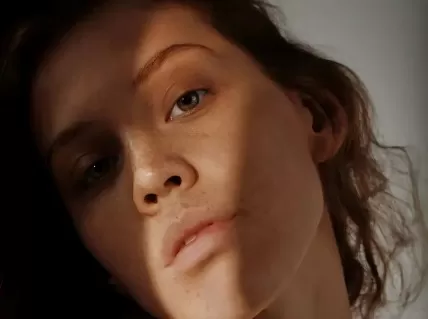 What Is Cortisol Face—And How Do You Know If You Have It?